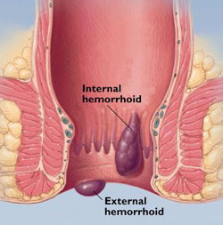 hemorroides
